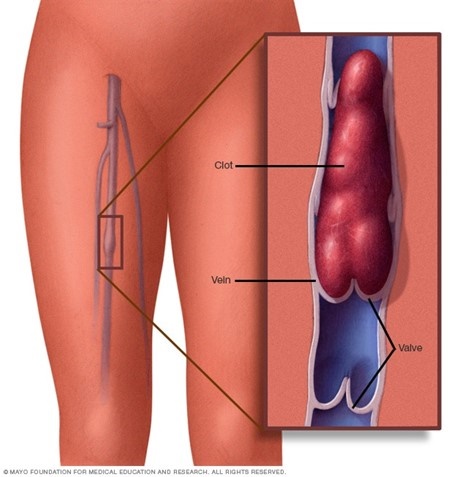 pulmonaryembolism24112020