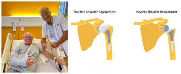 shoulderreplacement19092023