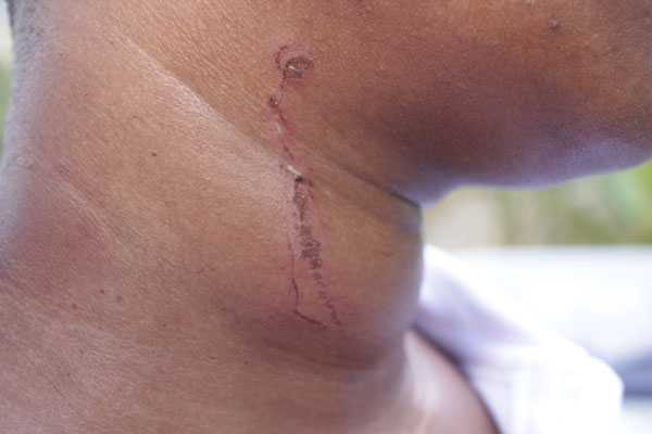 swollenneck17042011